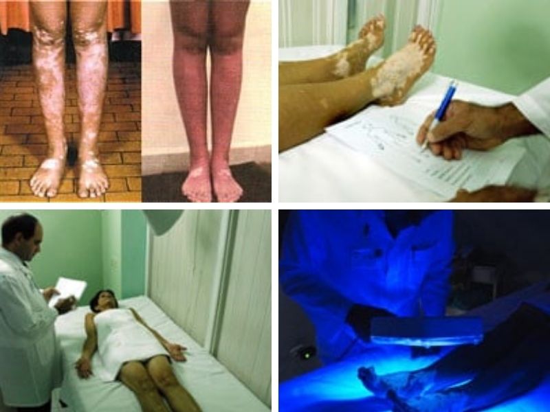 Tratamiento eficaz para la cura del vitiligo
